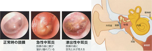 かむ バリバリ 鼻 耳 【気になるこの症状】急性中耳炎 鼻は正しくかみましょう